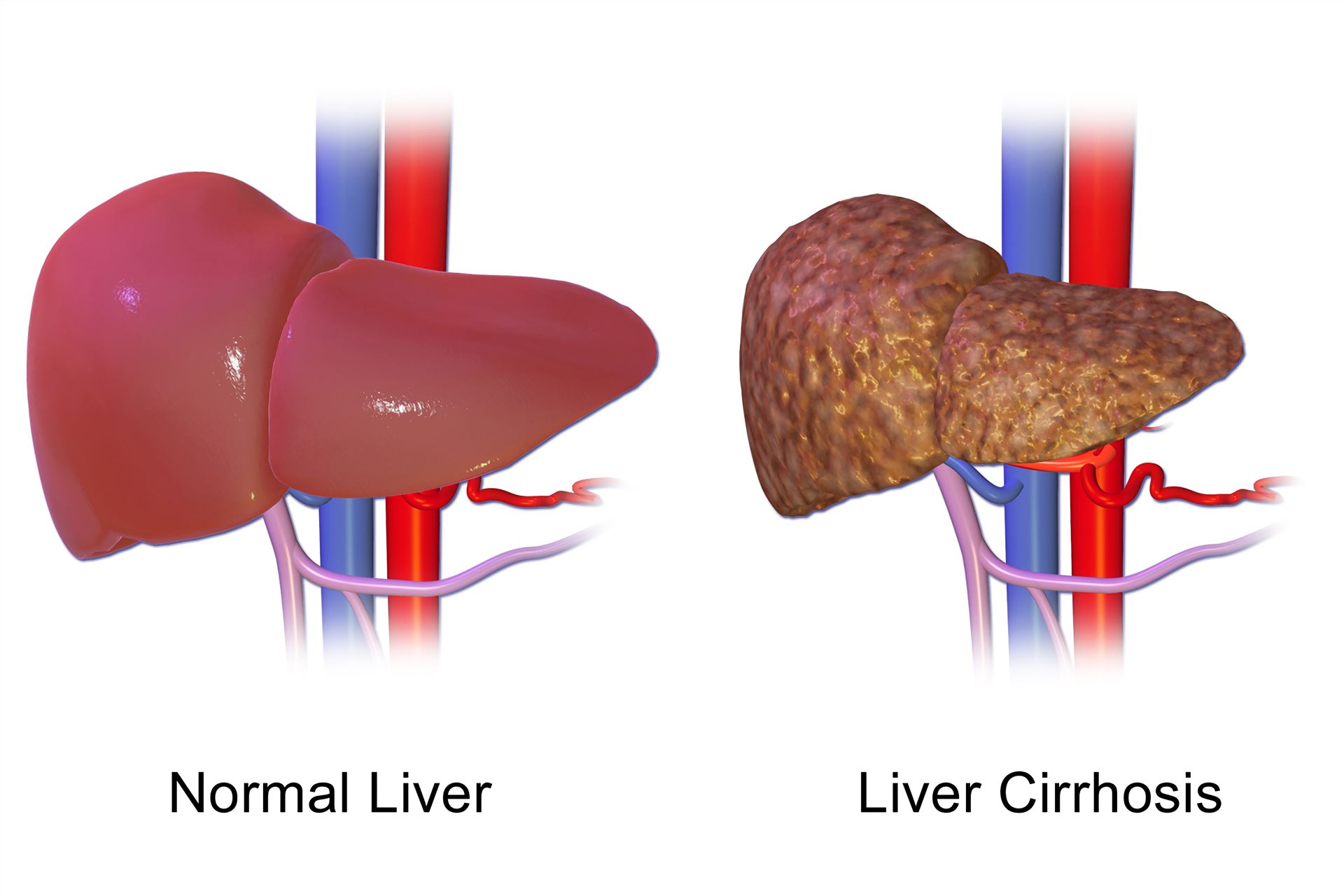Biomarkers and Antibodies Development for Liver Cirrhosis