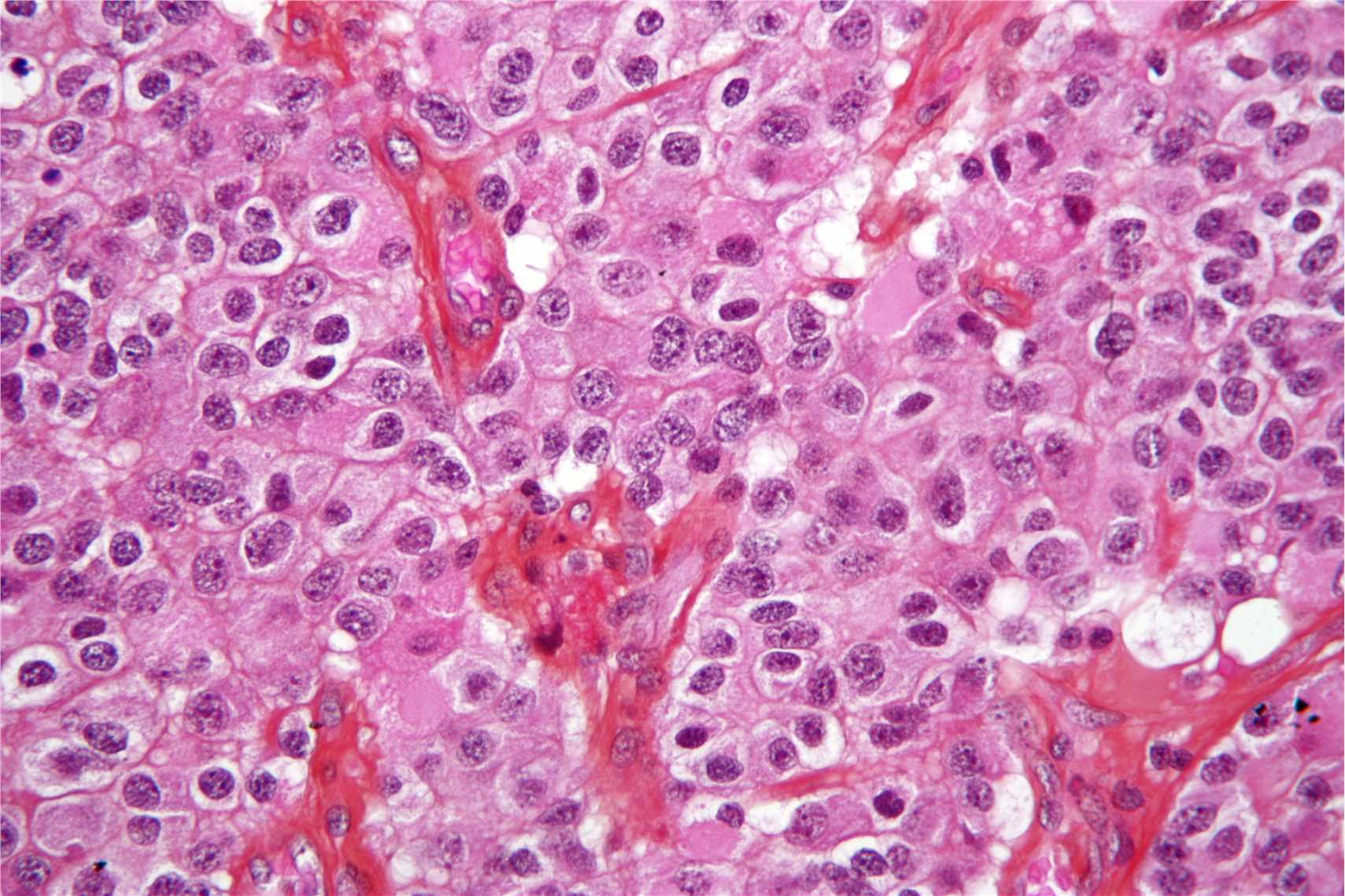 High magnification micrograph of an oligodendroglioma. H&E stain.