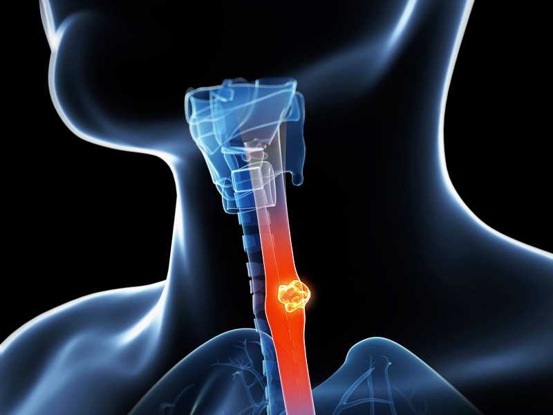 Biomarkers and Antibodies Development for Esophageal Cancer