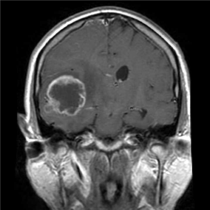 Glioblastoma on an MRI scan.