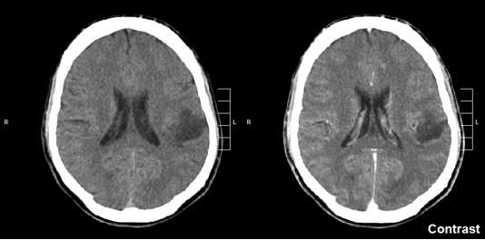 Images of glioma in the left parietal lobe (brain CT scan), WHO grade 2.