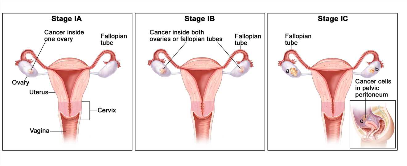 Biomarkers and Antibodies Development for Ovarian Cancer