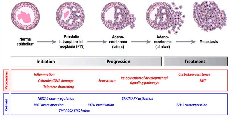 A schematic depicting the development of prostate cancer.