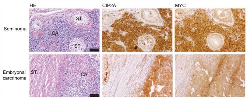 Microphotographs of CIP2A, MYC immunohistochemical staining in two different human testicular cancer samples, seminoma, and embryonal carcinoma.