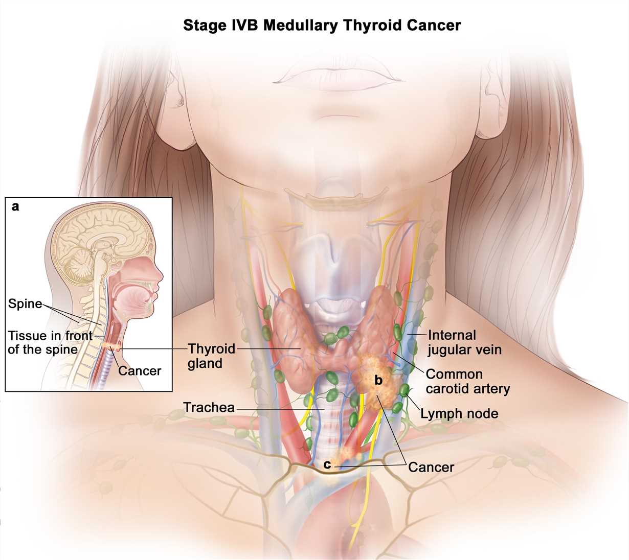 Biomarkers and Antibodies Development for Thyroid Cancer