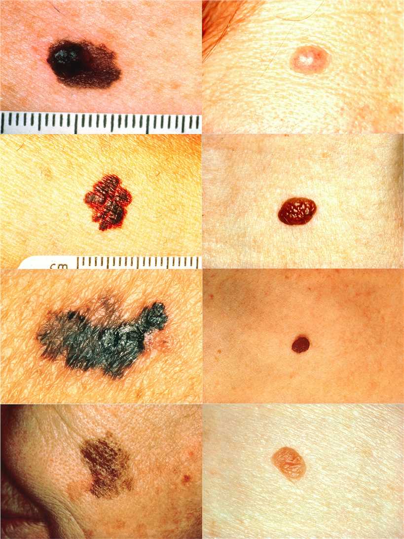 Images of melanoma.