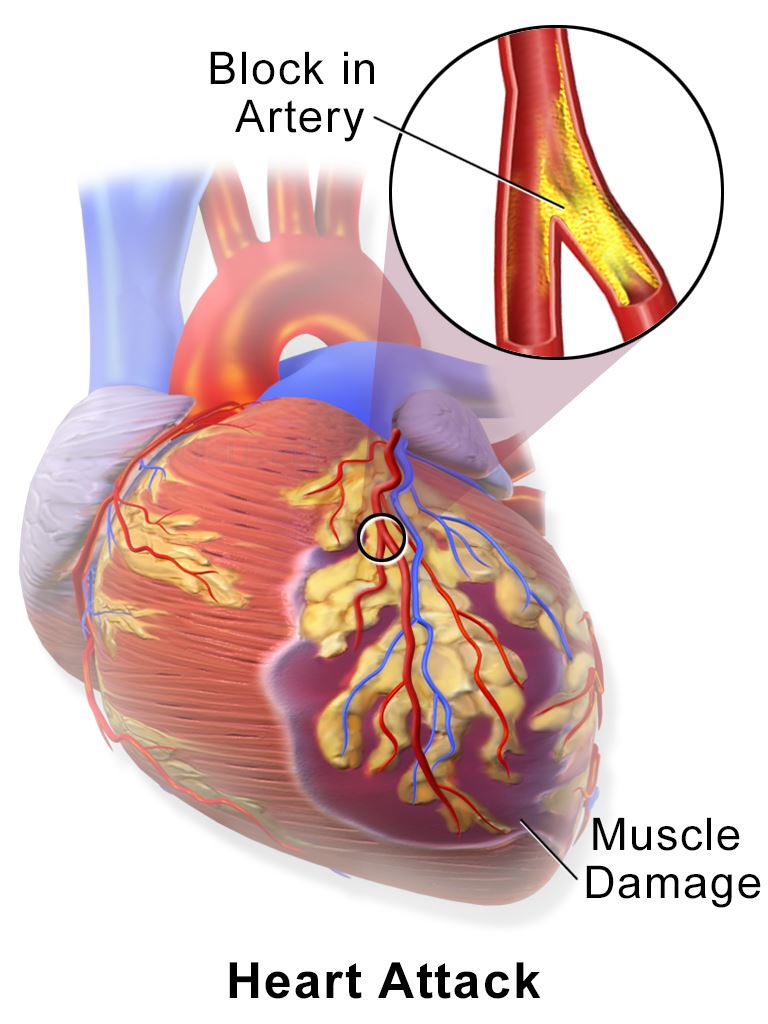 Schematic diagram of myocardial infarction or heart attack.