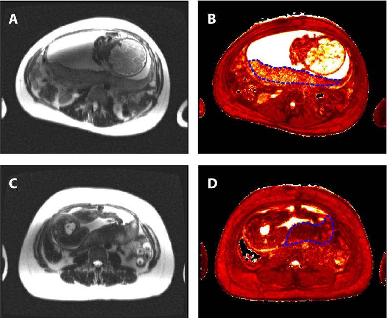 Early Asessment of Placental Function and Adverse Pregnancy Outcome by Novel MRI Method