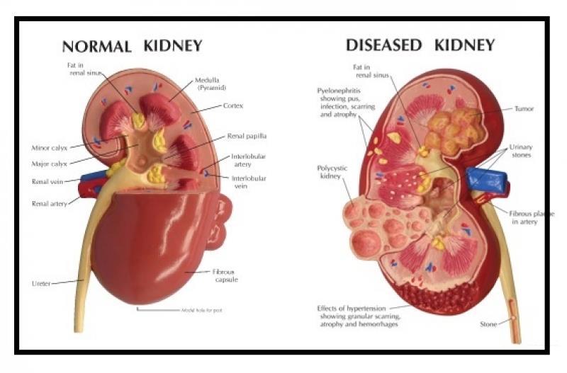 Normal kidney and diseased kidney.