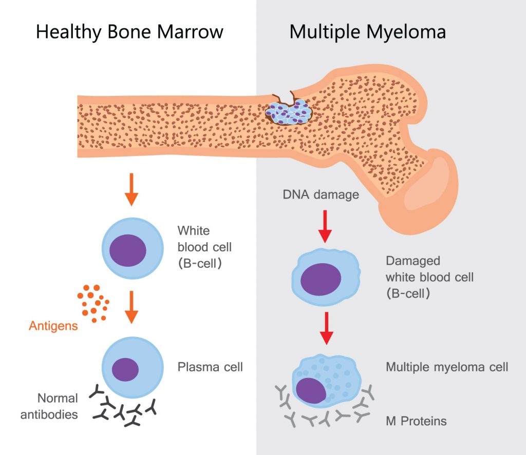 Multiple myeloma develops in plasma cells found in the bone marrow. Plasma cells are a type of white blood cells, an important part of your immune system