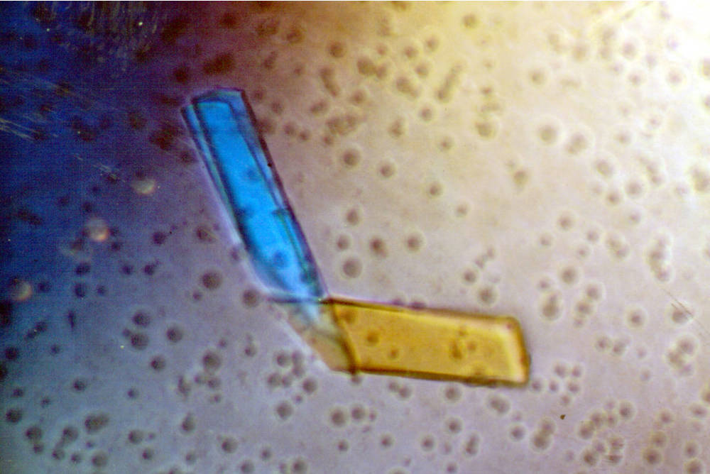 Pathology Of Multiple Myeloma Pathology Made Simple Hot Sex Picture