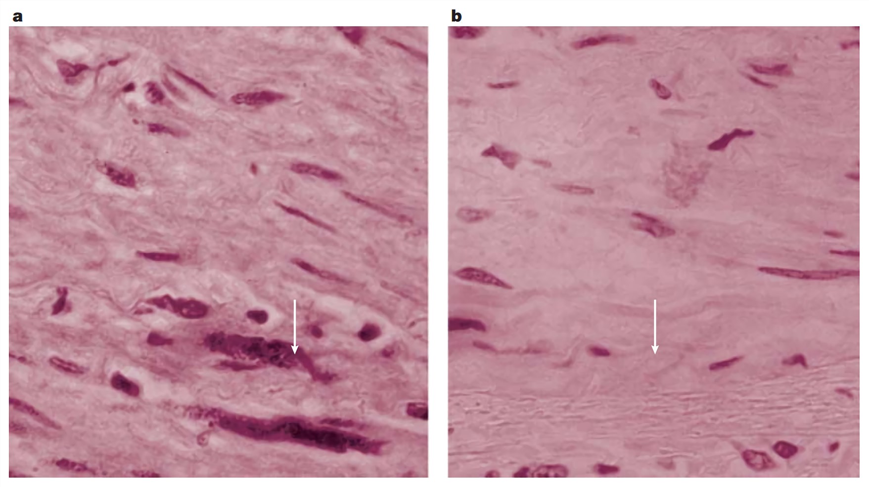 Immunocytochemical staining of a fibrous plaque of the coronary artery. a. Staining with a C. pneumoniae-specific monoclonal antibody. b. Staining with a control antibody. Arrows indicate positively stained foam cells.