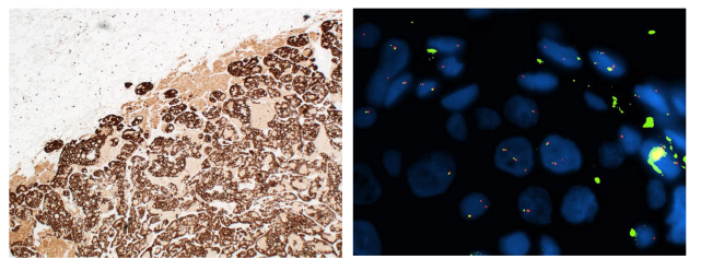 Two different testing methodology to identify NSCLC patients harbour an ALK gene rearrangement. ALK Immunohistochemistry (A) Positive ALK FISH test (B).