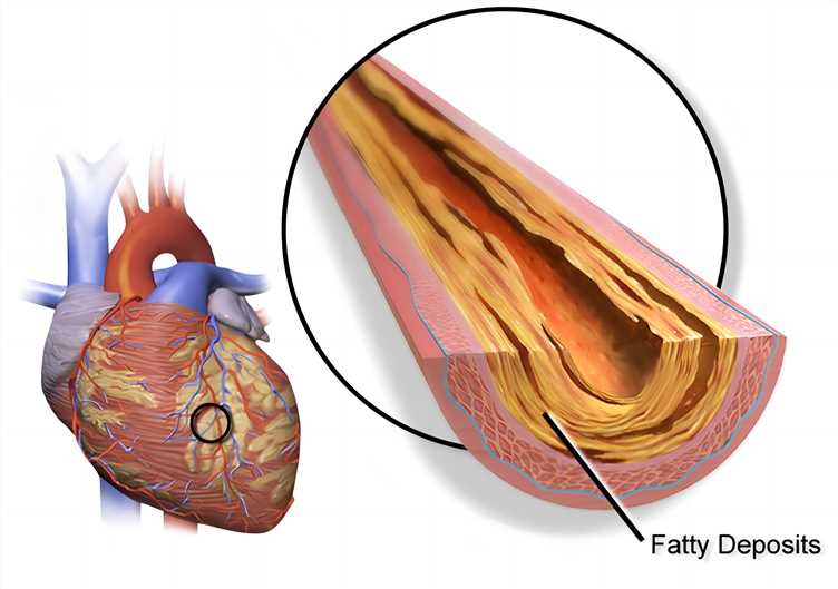 Coronary artery plaque.