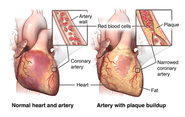 The picture shows the normal heart and artery as well as the artery with plaque buildup.