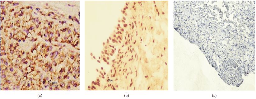 Immunohistochemistry images of BLCA-4 expression in the bladder cancer tissue (a), the adjacent normal tissue (b), and the normal tissue (c).