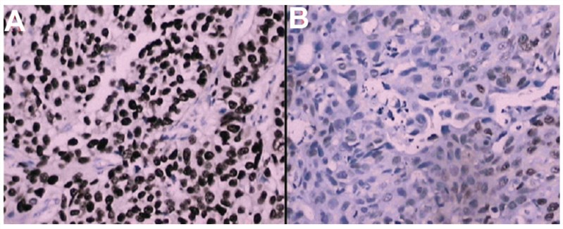 Immunohistochemical analysis of BLCA-4 in bladder cancer patients.