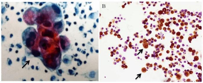 Positive rate of serum tumor markers in gastric and colorectal cancer according to tumor stage.