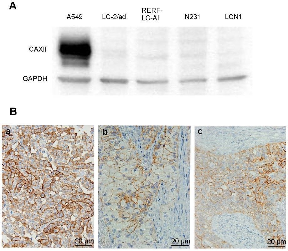 Expression of CAXII antibody in lung cancer cell lines and tissues.