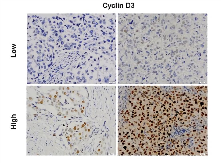 Cyclin D3 immunostaining is determined in breast cancer