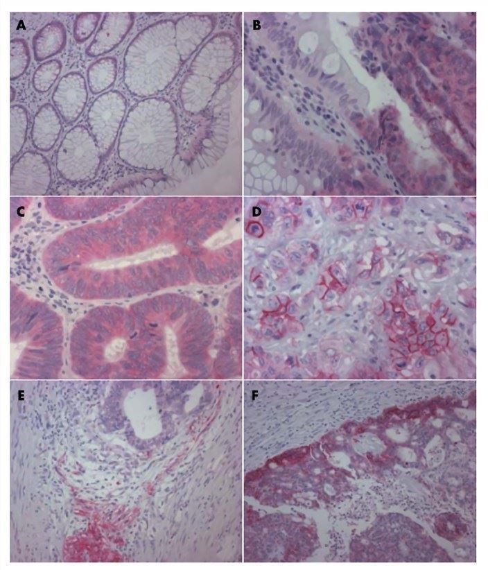 ALCAM immunohistochemistry in normal colon and colorectal cancer.