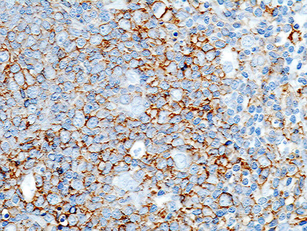 Image of Diffuse large B cell lymphoma for CD20.