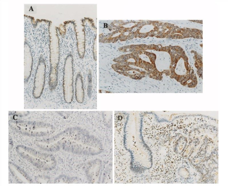 Immunostaining with antihuman CDC25B antibody in normal colonic mucosa and colorectal carcinoma tissues.