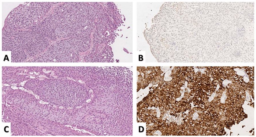 Microphotographs of CK20 expression in urothelial carcinoma.