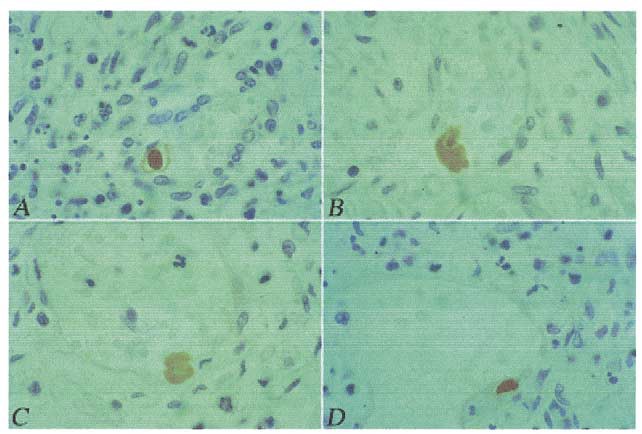 Immunohistochemical detection of human CMV p52 protein in cytomegalic endothelial cells present along the vessel wall or inside the blood vessels of the ovary of an AIDS patient deceased with disseminated human CMV infection.