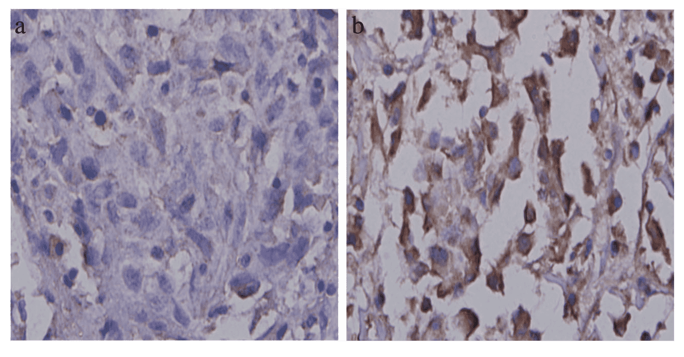 Immunohistochemical analysis of CR-1 in NSCLC patients. a Low expression level of CR-1. b High expression level of CR-1.