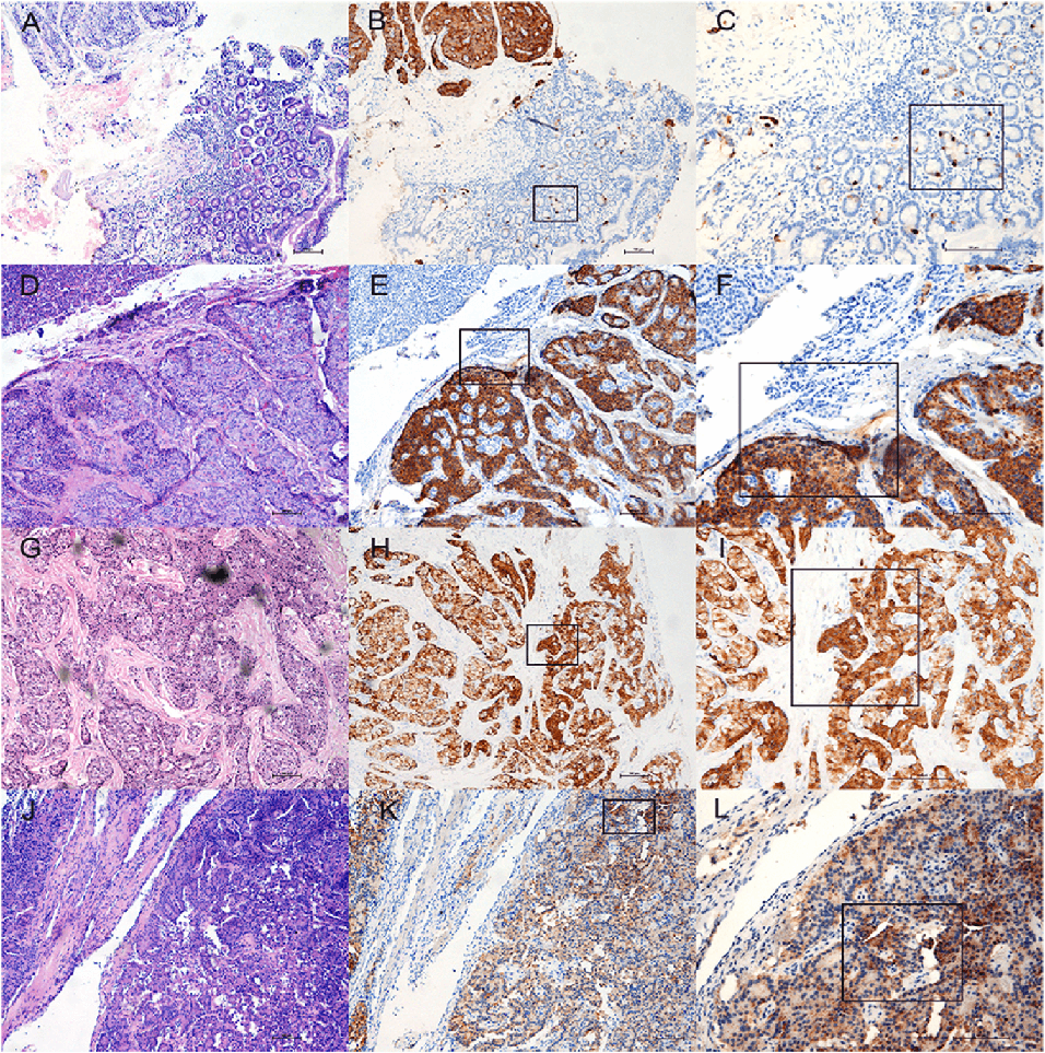 Representative examples of CgA expression in pancreatic NETs and their paired tissues.