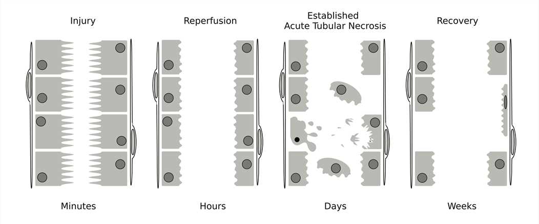 Fig.2 Pathophysiological changes in proximal renal tubules. (From Wiki: By ColnKurtz - Own work, https://commons.wikimedia.org/wiki/File:Acute_Renal_Failure.svg)