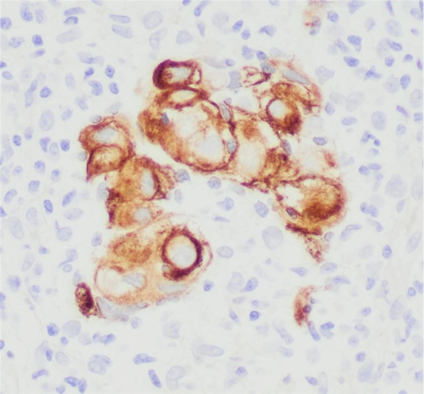 Immunohistochemistry for CK7 of a metastatic undifferentiated carcinoma to a lymph node. 
