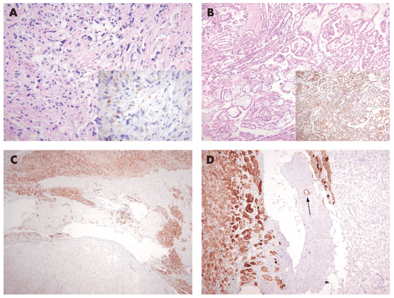 (A) (H&E) The adrenal cortical adenomas show strong cytoplasmic positivity for D2-40 (B). (C) (H&E) The adrenal cortical carcinomas are also strongly positive for D2-40 (D) although the cytoplasmic positivity is variable in intensity (inset).