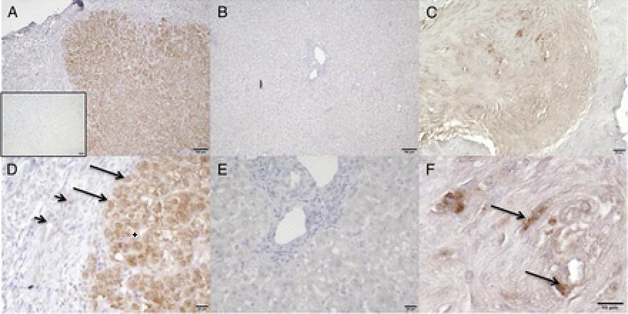 Expression of FGF23 in liver tissue from case 2 obtained at the time of Kasai portoenterostomy.