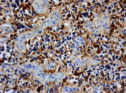 Image of glioblastoma GFAP.