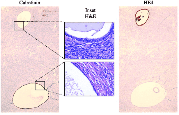 HE4 and calretinin exhibit differential expression in cortical inclusion cysts.