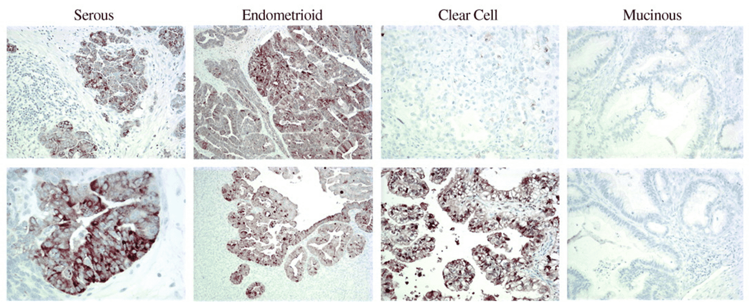 HE4 is expressed by subtypes of ovarian carcinomas.