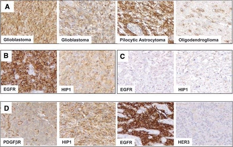 HIP1 expression in brain tumor tissue.