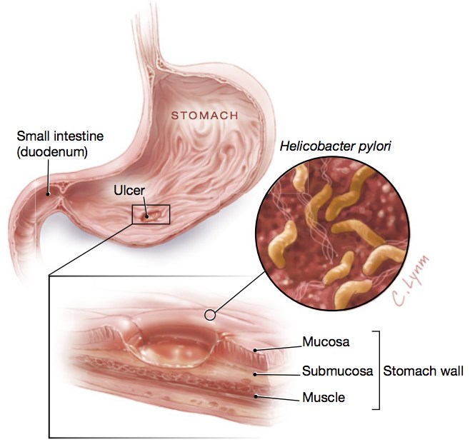Helicobacter pylori in the ulcer of stomach.