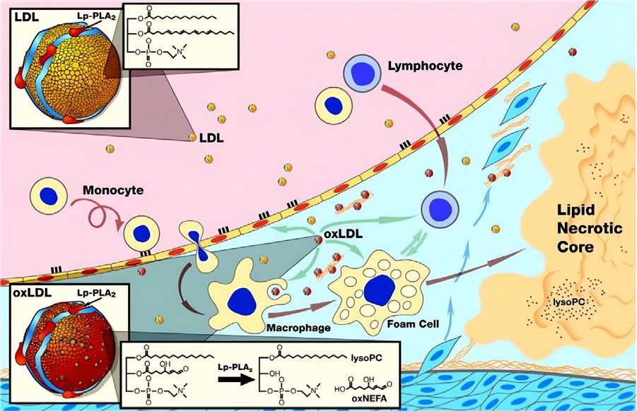 Fig.1 The proposed pro-atherogenic mechanism of LpPLA2 in the vessel wall. (Karakas & Koenig, 2010)