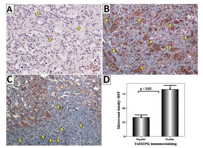 Double immunohistochemistry for pyruvate kinase M2 (M2-PK) and CD34 in representative sections of biliary tract cancer.