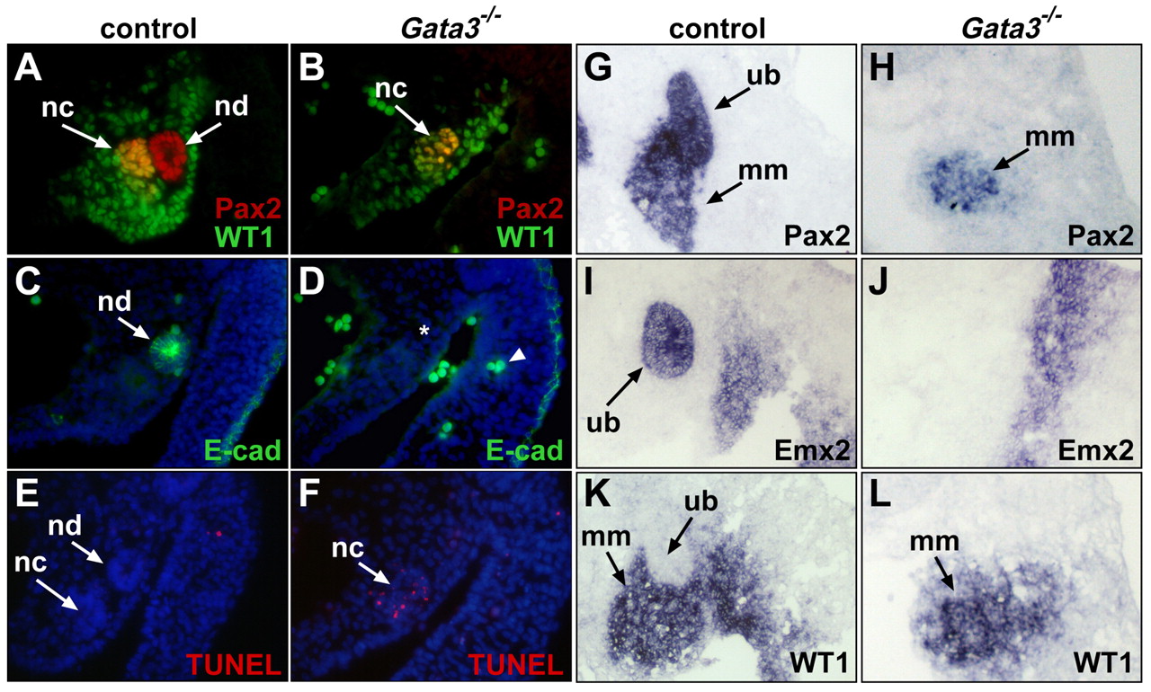 (A) Expression of PAX-2 protein in cancer cell lines. (B) Frequent expression of PAX-2 protein in primary human tumors.