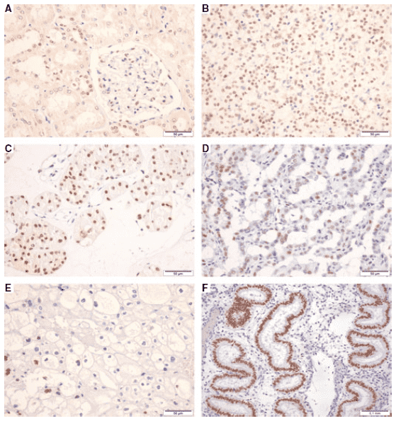 PAX-2 protein expression by immunohistochemical analysis in normal kidney (A), and endometrial glands (F) and renal cell tumours (C-E).