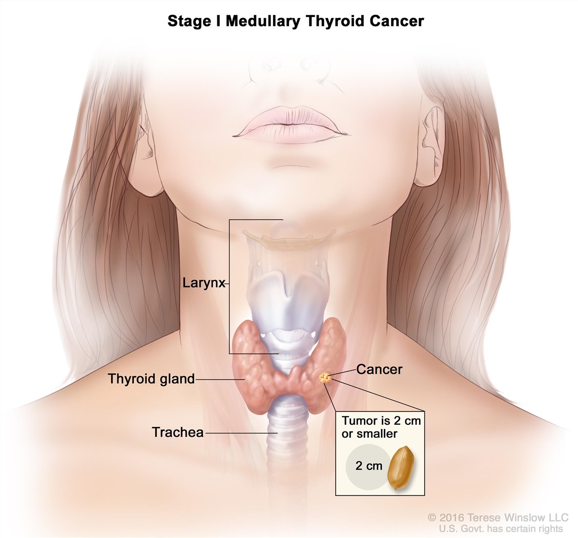 Medullary Thyroid Cancer.