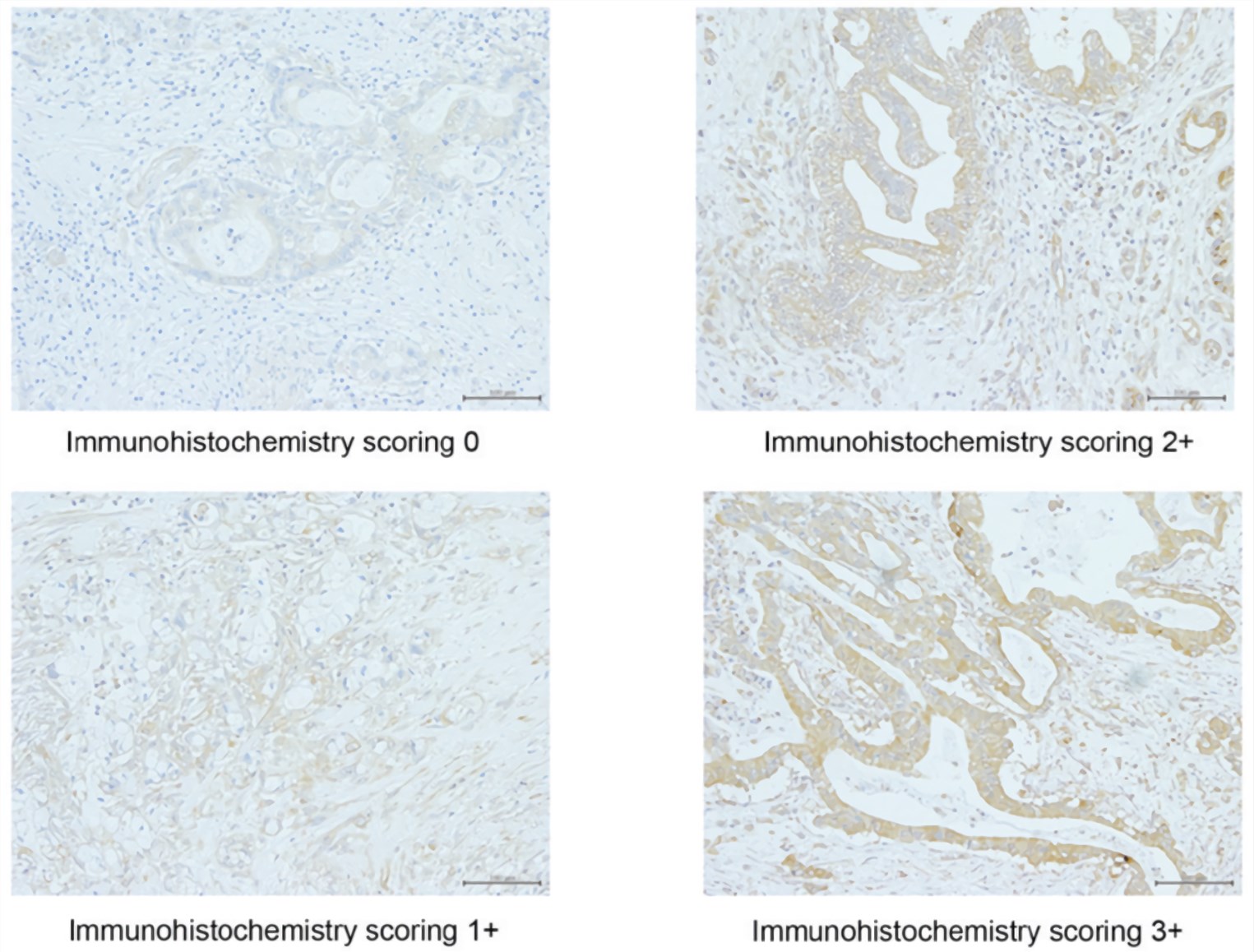 Representative results of the immunohistochemical staining of RRM1 in tissue samples from patients with pancreatic cancer (scale bar, 100 µm).