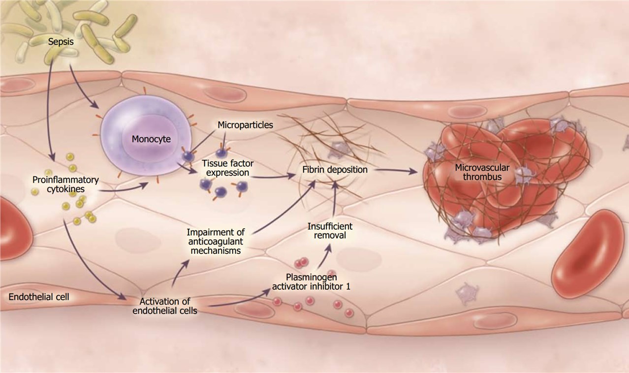 Fig.1 Pathogenesis of disseminated intravascular coagulation in sepsis.