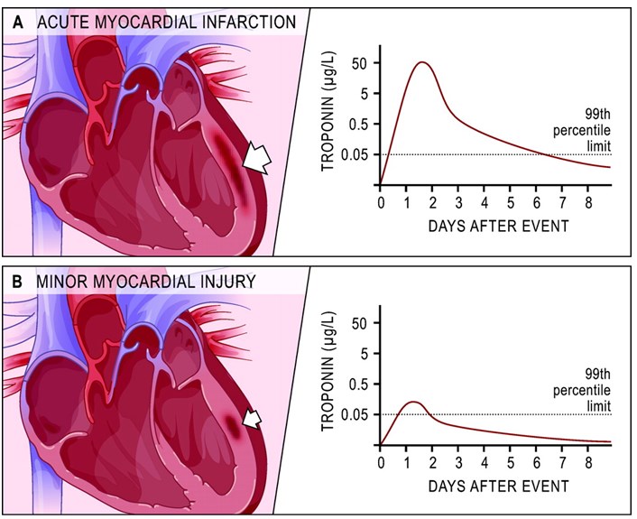 Part A shows the troponin release following AMI, part B shows the troponin release following minor myocardial injury. In AMI, troponin raises obviously above the 99th percentile limit (dotted line) within hours of symptom onset and then gradually reduces over several days.