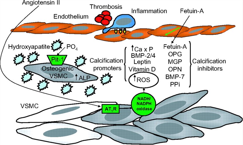 Mechanisms depicted here are some of those involved in vascular calcification in chronic kidney disease.