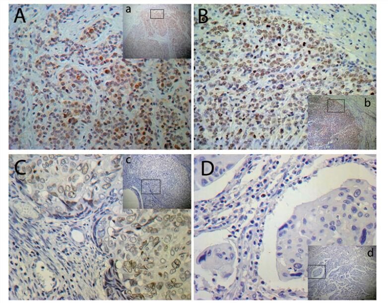 Representative immunohistochemical staining for MMSET expression in ovarian specimens and fallopian tube specimens.